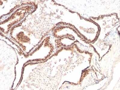 Immunohistochemistry-Paraffin: p27/Kip1 Antibody (KIP1/769) - Azide and BSA Free [NBP2-47769] - Human Prostate cancer stained with p27 Monoclonal Antibody (KIP1/769)