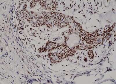 Immunohistochemistry-Paraffin: p27/Kip1 Antibody (RM302) [NBP2-61571] - Immunohistochemical staining of formalin fixed and paraffin embedded human breast cancer tissue section using NBP2-61571.