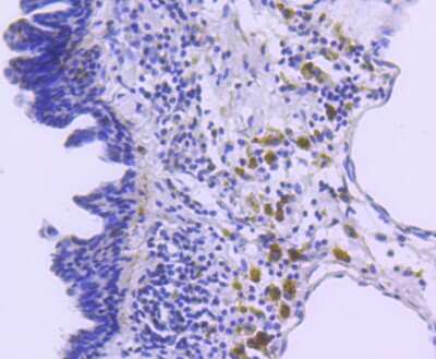 Immunohistochemistry-Paraffin: p27/Kip1 Antibody (SU37-04) [NBP2-67485] - Analysis of paraffin-embedded human breast carcinoma tissue using anti-p27 KIP 1 antibody. Counter stained with hematoxylin.