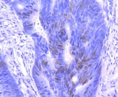 Immunohistochemistry-Paraffin: p27/Kip1 Antibody (SU37-04) [NBP2-67485] - Analysis of paraffin-embedded human colon cancer tissue using anti-p27 KIP 1 antibody. Counter stained with hematoxylin.