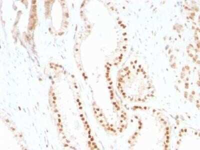 Immunohistochemistry-Paraffin: p27/Kip1 Antibody (SX53G8) - IHC-Prediluted [NBP2-44493] - Formain-fixed, paraffin-embedded human prostate Carcinoma stained with p27 Monoclonal Antibody (sx53G8)