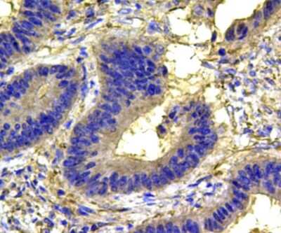 Immunohistochemistry-Paraffin: p38 alpha Antibody (9-B9) [NBP2-67002] - Analysis of paraffin-embedded human colon carcinoma tissue using anti-MAPK14 antibody. Counter stained with hematoxylin.