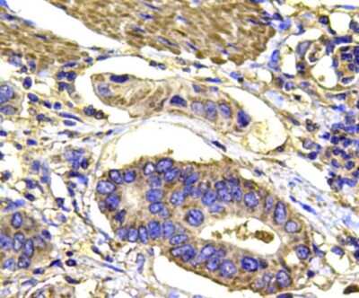 Immunohistochemistry-Paraffin: p38 alpha Antibody (9-B9) [NBP2-67002] - Analysis of paraffin-embedded human stomach carcinoma tissue using anti-MAPK14 antibody. Counter stained with hematoxylin.