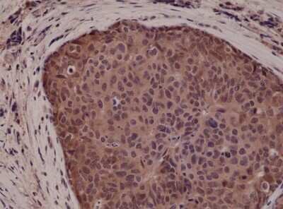 Immunohistochemistry-Paraffin: p38 alpha Antibody (RM245) [NBP2-61575] - Immunohistochemical staining of formalin fixed and paraffin embedded human breast cancer tissue sections using NBP2-61575.