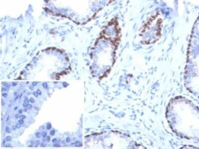 Immunohistochemistry-Paraffin: p40/deltaNp63 Antibody (P40/7302R) [NBP3-13806] - Formalin-fixed, paraffin-embedded human prostate cancer stained with p40/deltaNp63 antibody (P40/7302R). Inset: PBS instead of primary antibody, secondary antibody negative control.