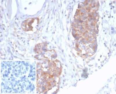 Immunohistochemistry-Paraffin: p40/deltaNp63 Antibody (P40/7302R) [NBP3-13806] - Formalin-fixed, paraffin-embedded human ovarian cancer stained with p40/deltaNp63 antibody (P40/7302R). Inset: PBS instead of primary antibody; secondary only negative control.