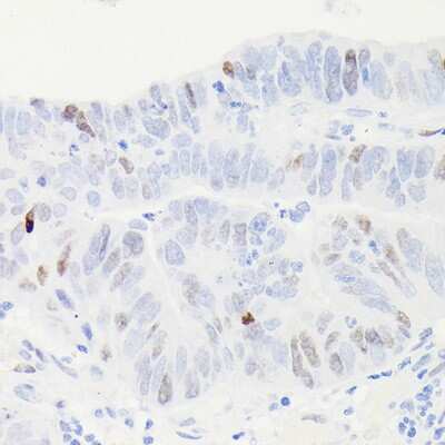 Immunohistochemistry-Paraffin: p53 Antibody (9L6E2) [NBP3-15792] - Immunohistochemistry of paraffin-embedded human colon carcinoma using [KO Validated] p53 Rabbit mAb (NBP3-15792) at dilution of 1:100 (40x lens).Perform high pressure antigen retrieval with 10 mM citrate buffer pH 6.0 before commencing with IHC staining protocol.