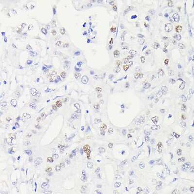 Immunohistochemistry-Paraffin: p53 Antibody (9L6E2) [NBP3-15792] - Immunohistochemistry of paraffin-embedded Human hepatocholangiocarcinoma using [KO Validated] p53 Rabbit mAb (NBP3-15792) at dilution of 1:100 (40x lens).Perform high pressure antigen retrieval with 10 mM citrate buffer pH 6.0 before commencing with IHC staining protocol.