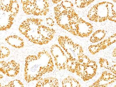 Immunohistochemistry-Paraffin: p53 Antibody (DO-7) [NBP2-34308] - Formalin-fixed, paraffin-embedded human colon stained with p53 MAb (DO-7)