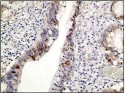 Immunohistochemistry-Paraffin: p53 Antibody (M26-A) [NBP1-78987] - Formalin-fixed and paraffin-embedded human colon carcinoma tissue (4 um) stained with  anti-p53  antibody shows positive nuclear immunostaining of tumor cells. Kindly performed and provided by Katarina Poliakova, MD and Lubomir Straka, MD, Ph. D. from Clinical Pathology Presov, Ltd., Presov, Slovak republic.
