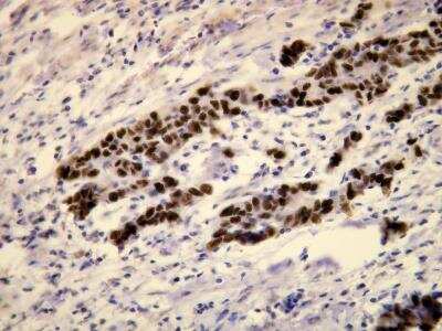 Immunohistochemistry-Paraffin: p53 Antibody (M26-A) [NBP1-78987] - Ovarian high grade serous carcinoma with diffuse strong nuclear p53 expression. Formalin fixed, paraffin embedded human tissue (4 um section) stained with anti - p53 monospecific clonal antibody.