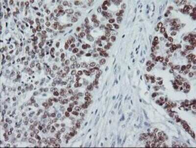 Immunohistochemistry: p53 Antibody (OTI5E2) - Azide and BSA Free [NBP2-73200] - Staining of paraffin-embedded Adenocarcinoma of Human ovary tissue using anti-p53 mouse monoclonal antibody.