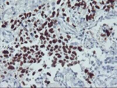 Immunohistochemistry: p53 Antibody (OTI5E2) - Azide and BSA Free [NBP2-73200] - Staining of paraffin-embedded Carcinoma of Human lung tissue using anti-p53 mouse monoclonal antibody.