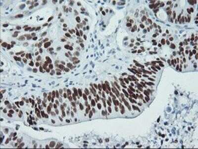 Immunohistochemistry: p53 Antibody (OTI5E2) - Azide and BSA Free [NBP2-73200] - Staining of paraffin-embedded Carcinoma of Human pancreas tissue using anti-p53 mouse monoclonal antibody.