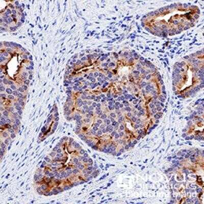 Immunohistochemistry: p53 Antibody (PAb 240) - Azide and BSA Free [NBP2-80898] - p53 was detected in immersion fixed paraffin-embedded sections of human prostate cancer using anti-human mouse monoclonal antibody (Catalog # NB200-103) at 1:200 dilution overnight at 4C. Tissue was stained using the VisuCyte anti-mouse HRP polymer detect