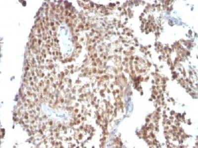 Immunohistochemistry-Paraffin: p53 Antibody (SPM590) - Azide and BSA Free [NBP2-34434] - Formalin-fixed, paraffin-embedded human colon carcinoma stained with P53 Monoclonal antibody (SPM590)