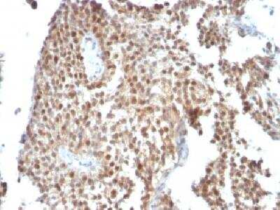 Immunohistochemistry-Paraffin: p53 Antibody (SPM590) [NBP2-34387] - Formalin-fixed, paraffin-embedded human colon carcinoma stained with P53 Monoclonal antibody (SPM590)