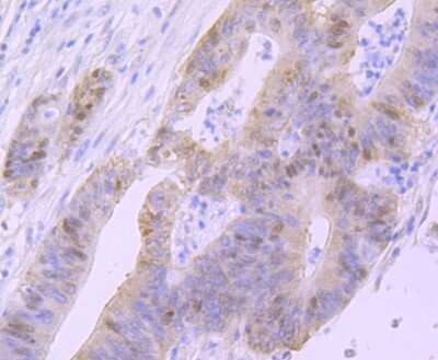 Immunohistochemistry-Paraffin: p53 Antibody (SY010-6) [NBP2-67007] - Analysis of paraffin-embedded human colon cancer tissue using anti-p53 antibody. Counter stained with hematoxylin.