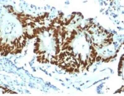 Immunohistochemistry-Paraffin: p53 Antibody (TP53/1799R) - Azide and BSA Free [NBP2-59632] - Formalin-fixed, paraffin-embedded human Colon Carcinoma stained withp53 Recombinant Rabbit Monoclonal Antibody (TP53/1799R)