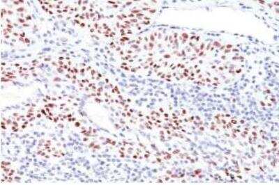 Immunohistochemistry-Paraffin: p53 Antibody (TRP/816) [NBP2-59626] - Formalin-fixed, paraffin-embedded human Bladder Carcinoma stained with  p53 Mouse Monoclonal Antibody (TRP/816).