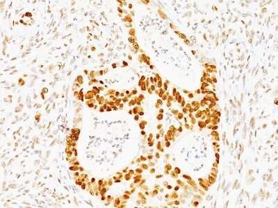 Immunohistochemistry-Paraffin: p53 Antibody (TRP/817) [NBP2-44982] - Human Colon Carcinoma stained with p53 Monoclonal Antibody (TRP/817)