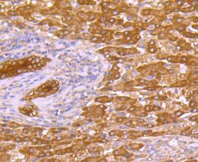 Immunohistochemistry: p53 DINP1 Antibody (JG37-64) [NBP2-76860] - Immunohistochemical analysis of paraffin-embedded huamn liver cancer tissue using anti-p53DINP1 antibody. Counter stained with hematoxylin.