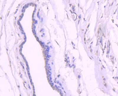 Immunohistochemistry-Paraffin: p53 [ac Lys382] Antibody (SD0801) [NBP2-67804] - Analysis of paraffin-embedded human breast carcinoma tissue using anti-p53 (acetyl K382) antibody. Counter stained with hematoxylin.