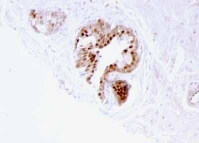 Immunohistochemistry-Paraffin: p57 Kip2 Antibody (57P06) - Azide and BSA Free [NBP2-47768] - Human Prostate Carcinoma stained with p57 Kip2 Antibody (KIP2/880).