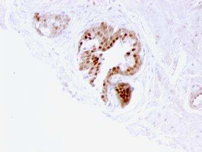 Immunohistochemistry-Paraffin: p57 Kip2 Antibody (57P06) - IHC-Prediluted [NBP2-48153] - Human Prostate Carcinoma stained with p57 Mouse Monoclonal Antibody (57P06).