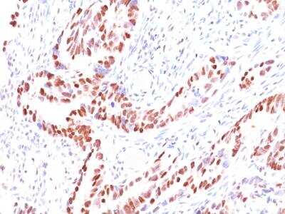 Immunohistochemistry-Paraffin: p57 Kip2 Antibody (KIP2/880) - IHC-Prediluted [NBP2-48133] - Formalin-fixed, paraffin-embedded human Colon Carcinoma stained with p57 Mouse Monoclonal Antibody (KIP2/880).