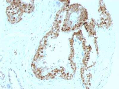 Immunohistochemistry-Paraffin: p57 Kip2 Antibody (KIP2/880) - IHC-Prediluted [NBP2-48133] - Formalin-fixed, paraffin-embedded human Prostate Carcinoma stained with p57 Mouse Monoclonal Antibody (KIP2/880).