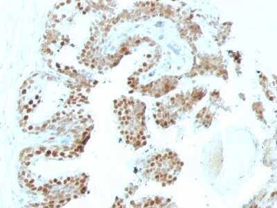 Immunohistochemistry-Paraffin: p57 Kip2 Antibody (KP10 + KIP2/880) - IHC-Prediluted [NBP2-48134] - Human Prostate Carcinoma stained with p57 Monoclonal Antibody (KP10+KIP2/880).