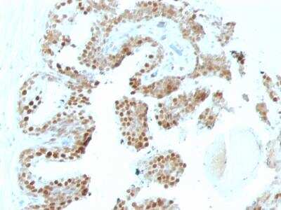 Immunohistochemistry-Paraffin: p57 Kip2 Antibody (SPM308) - IHC-Prediluted [NBP2-48424] - Formalin-fixed, paraffin-embedded human Prostate Carcinoma stained with p57 Mouse Monoclonal Antibody (SPM308).