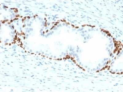 Immunohistochemistry-Paraffin: p63/TP73L Antibody (TP63/2428) - Azide and BSA Free [NBP3-08736] - Formalin-fixed, paraffin-embedded human prostate carcinoma stained with p63/TP73L Mouse Monoclonal Antibody (TP63/2428).