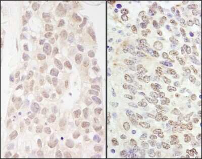 <b>Independent Antibodies Validation and Biological Strategies Validation.</b>Immunohistochemistry: p66 beta Antibody [NB100-60646] - Sample: FFPE section of human breast carcinoma (left) and mouse teratoma (right). Antibody: Affinity purified rabbit anti- p66beta/GATAD2B used at a dilution of 1:200 (1ug/ml). Detection: DAB