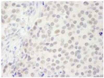 Immunohistochemistry-Paraffin: p66 beta Antibody [NB100-60646] - Human small cell lung cancer. Antibody: Affinity purified rabbit antip66beta/GATAD2B used at a dilution of 1:250.