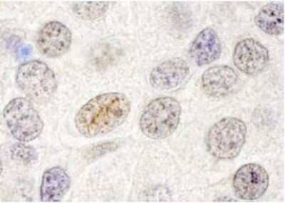 Immunohistochemistry-Paraffin: p66 beta Antibody [NB100-60646] - Human small cell lung cancer. Antibody: Affinity purified rabbit antip66beta/GATAD2B used at a dilution of 1:250.
