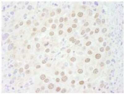 Immunohistochemistry-Paraffin: p66 beta Antibody [NB100-60646] - Human small cell lung cancer. Antibody: Affinity purified rabbit antip66beta/GATAD2B used at a dilution of 1:250.