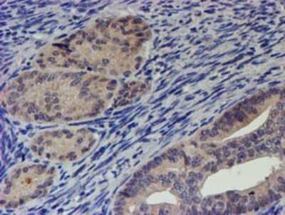 Immunohistochemistry: p70 S6 Kinase/S6K Antibody (OTI1G4) - Azide and BSA Free [NBP2-73209] - Staining of paraffin-embedded Adenocarcinoma of Human endometrium tissue using anti-S6K mouse monoclonal antibody.