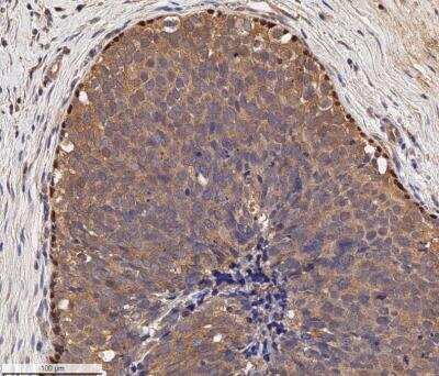 Immunohistochemistry-Paraffin: p73 Antibody (5B1288) [NB100-56674] - Human breast cancer section using 10ug/mL of p73 antibody (clone 5B1288) on a Bond Rx autostainer (Leica Biosystems). The assay involved 20 minutes of heat induced antigen retrieval (HIER) with 10 mM sodium citrate buffer (pH 6.0) and endogenous peroxidase quenching using peroxide block. The sections were incubated with primary antibody for 30 minutes. Bond Polymer Refine Detection (Leica Biosystems) and DAB were used for signal detection which followed counterstaining with hematoxylin. Whole slide scanning and capturing of representative images (20X) were performed using Aperio AT2 (Leica Biosystems). The cancer cells showed cytoplasmic immunoreactivity for p73 and the signal was very weak in the core and stroma of tumors. Peripheral cells of tumor areas, apparently the myoepithelial cells, showed a strong nuclear staining of p73.