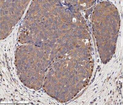 Immunohistochemistry-Paraffin: p73 Antibody (5B1288) [NB100-56674] - Human breast cancer section using 10 ug/mL of p73 antibody (clone 5B1288) on a Bond Rx autostainer (Leica Biosystems). The assay involved 20 minutes of heat induced antigen retrieval (HIER) with 10 mM sodium citrate buffer (pH 6.0) and endogenous peroxidase quenching using peroxide block. The sections were incubated with primary antibody for 30 minutes. Bond Polymer Refine Detection (Leica Biosystems) and DAB were used for signal detection which followed counterstaining with hematoxylin. Whole slide scanning and capturing of representative images (20X) were performed using Aperio AT2 (Leica Biosystems). The cancer cells showed cytoplasmic immunoreactivity for p73 and the signal was very weak in the core and stroma of tumors. Peripheral cells of tumor areas, apparently the myoepithelial cells, showed a strong nuclear staining of p73.