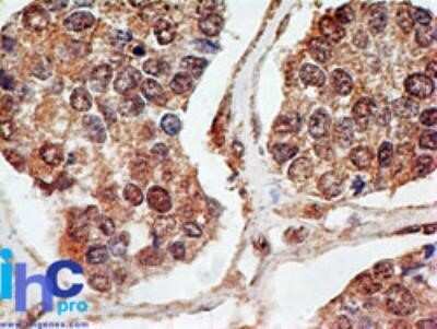 Immunohistochemistry-Paraffin: p73 Antibody (5B429) - Azide Free [NBP2-33259] - FFPE breast cancer probed with p73 antibody at 5 ug/ml. Human tissue was used for this test. Staining of tissues is enhanced by boiling tissue sections in 10 mM sodium citrate buffer, pH 6.0 for 10-20 min followed by cooling at RT for 20 min. Image from t