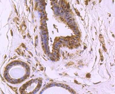 Immunohistochemistry-Paraffin: p97/VCP Antibody (JM11-15) [NBP2-67008] - Analysis of paraffin-embedded human breast cancer tissue using anti-VCP antibody. Counter stained with hematoxylin.