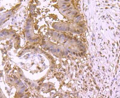 Immunohistochemistry-Paraffin: p97/VCP Antibody (JM11-15) [NBP2-67008] - Analysis of paraffin-embedded human colon cancer tissue using anti-VCP antibody. Counter stained with hematoxylin.