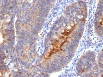 Immunohistochemistry-Paraffin: ECM-1/Secretory Component P85 Antibody (SC05) - IHC-Prediluted [NBP3-05763] - IHC-Prediluted - Formalin-fixed, paraffin-embedded human Colon Carcinoma.