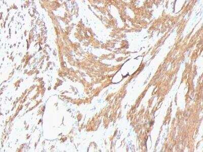 Immunohistochemistry-Paraffin: Actin (Muscle Specific) Antibody (HHF35 + MSA/953) - Azide and BSA Free [NBP2-47663] - Human Leiomyosarcoma stained with Muscle Specific Actin Monoclonal Antibody (HHF35 + MSA/953)