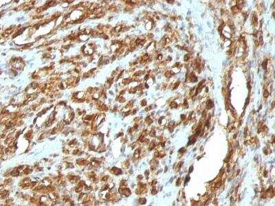 Immunohistochemistry-Paraffin: Actin (Muscle Specific) Antibody (HHF35 + MSA/953) - Azide and BSA Free [NBP2-47663] - Human Rhabdomyosarcoma stained with Muscle Specific Actin Monoclonal Antibody (HHF35 + MSA/953)