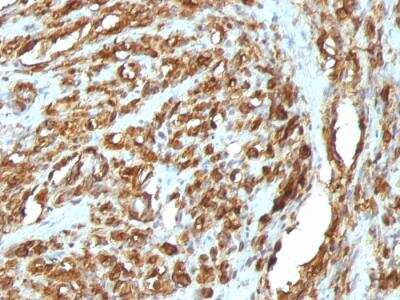 Immunohistochemistry-Paraffin: Actin (Muscle Specific) Antibody (HHF35 + MSA/953) - IHC-Prediluted [NBP2-48194] - Formalin-fixed, paraffin-embedded human Rhabdomyosarcoma stained with Muscle Specific Actin MAb (HHF35 + MSA/953)