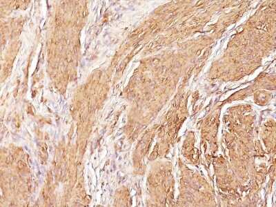 Immunohistochemistry-Paraffin: Actin (Muscle Specific) Antibody (SPM160) - Azide and BSA Free [NBP2-34399] - Formalin-paraffin leiomyosarcoma (20X) stained with muscle specific actin MAb (SPM160)