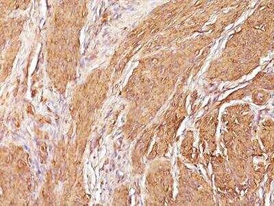 Immunohistochemistry-Paraffin: Actin (Muscle Specific) Antibody (SPM160) - IHC-Prediluted [NBP2-48188] - Formalin-fixed, paraffin-embedded human Leiomyosarcoma stained with Muscle Specific Actin Monoclonal Antibody (SPM160)